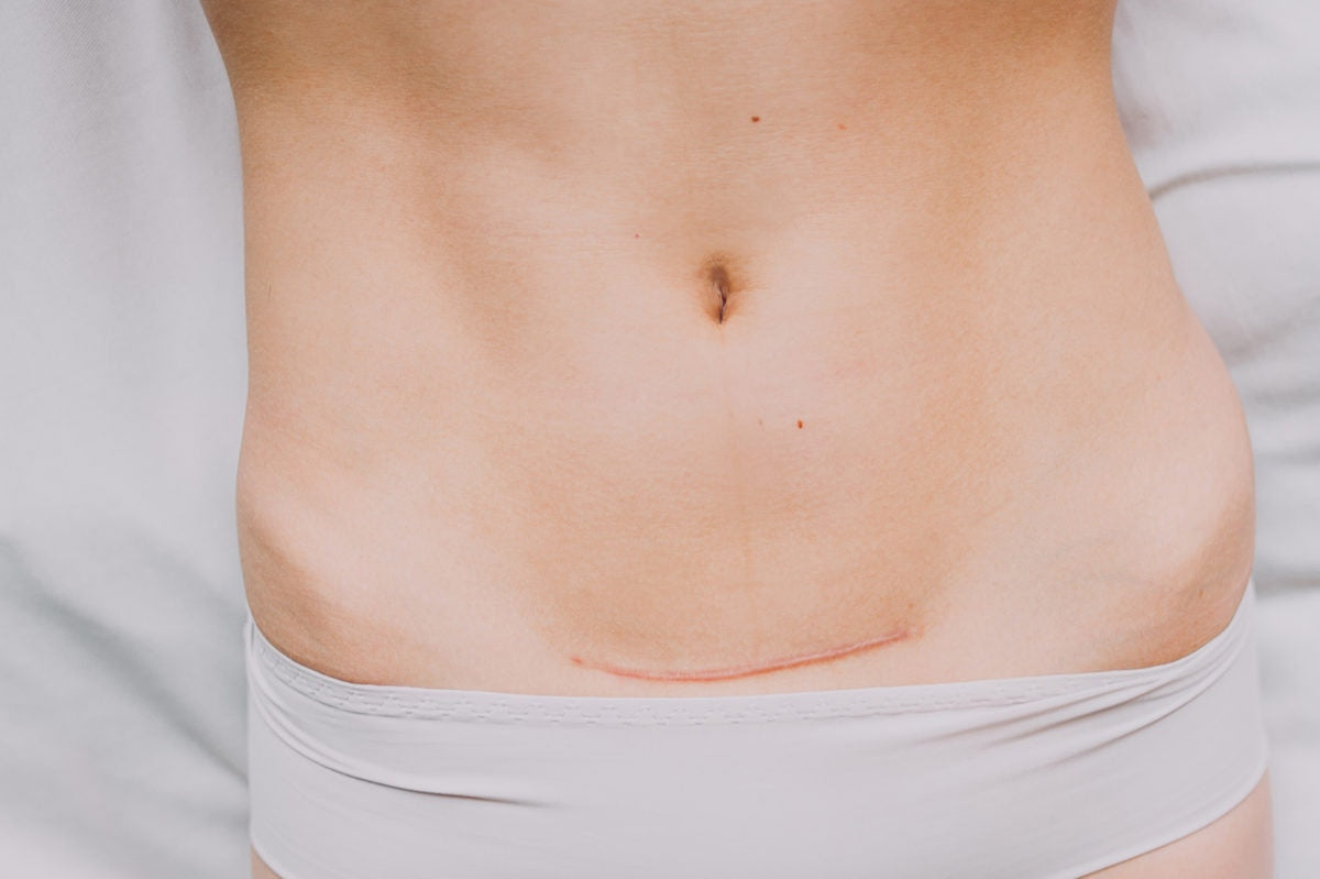 lady with scar in stomach